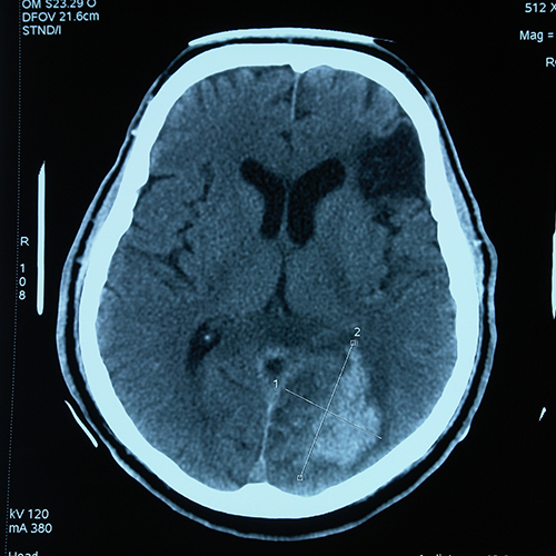 Photo of brain